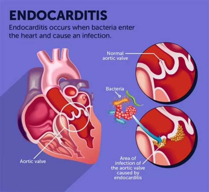 Can MSSA cause endocarditis?