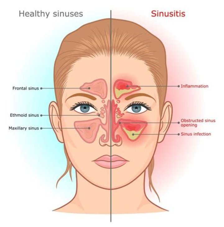 Can sinusitis cause scalp tenderness?