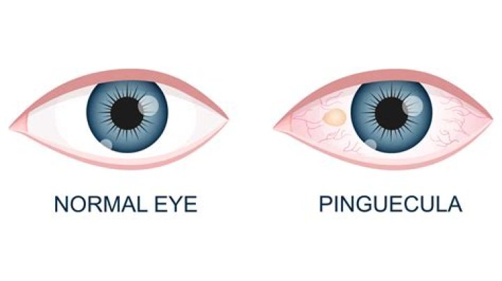 Does a pinguecula go away?