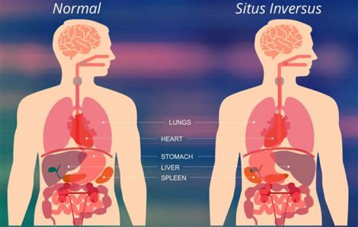Is situs inversus hereditary?