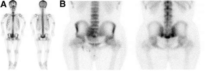 What does abnormal uptake on a bone scan mean?