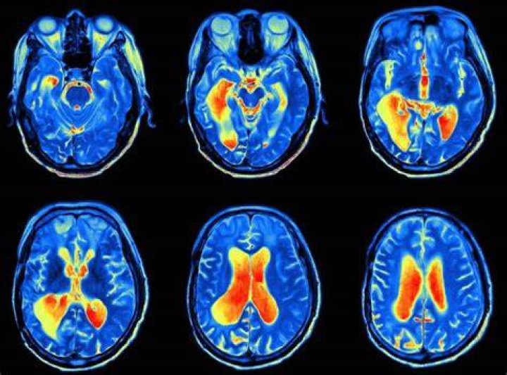 What is toxic encephalopathy?