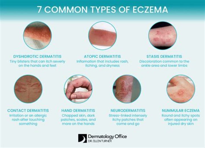 Why am I getting nummular eczema?
